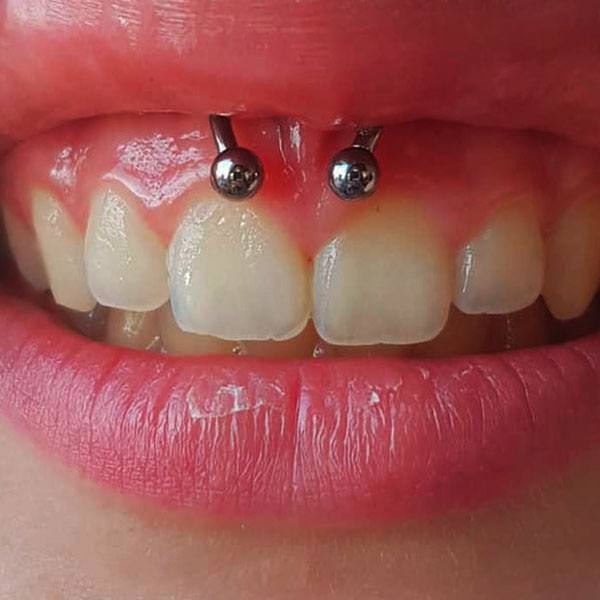 Get your smiley on! The ultimate guide to smiley piercing